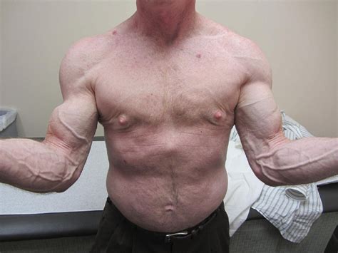 Failure of Biceps Tenodesis With Interference Screw Fixation - Arthroscopy
