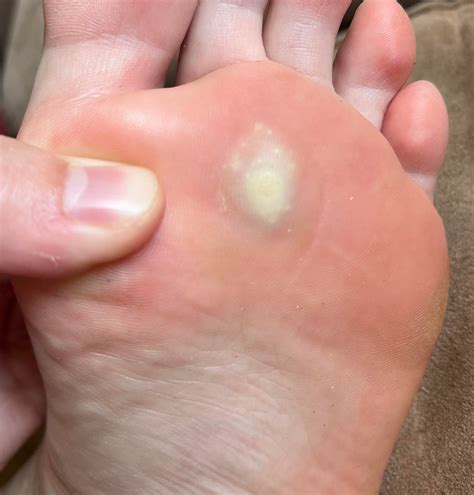 Stubborn plantar wart : r/Warts