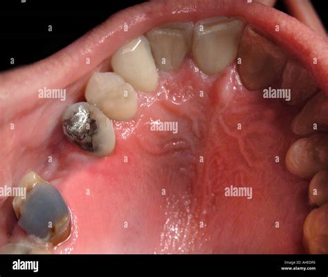 close   rows  teeth tooth     mouth stock photo