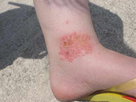 Jellyfish Eggs Rash at Amy Heyer blog