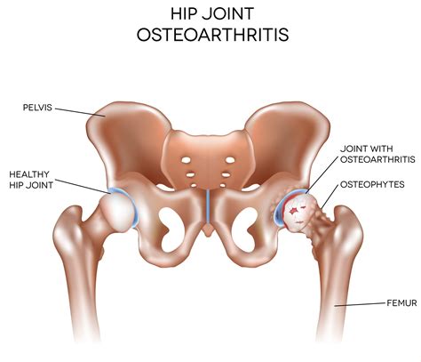 Osteoarthritis | SportsIn Orthopaedic Clinic | Dr Bernard Lee