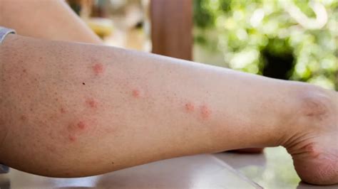 piqure de puce comment la reconnaitre  la soulager sanipure