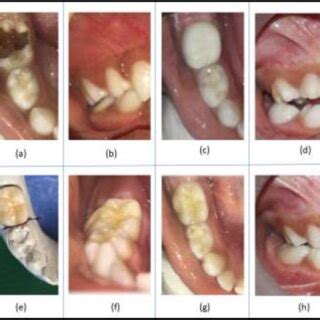 shows  grossly decayed   mandibular primary molar
