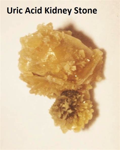 Vitamin C Uric Acid Kidney Stones at Ella Kendall blog