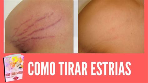 O Que Tira As Estrias - Como Eliminar Estrias? Guia Completo Como Tirar Estrias - YouTube