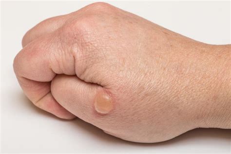 Bolhas De Água Na Mão - Bolhas de água na pele: causas e como curá-las - RÁPIDO E SEM MARCAS!