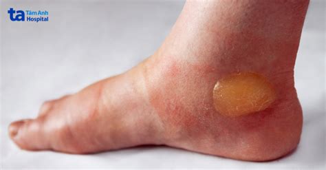 pemphigoid bong nuoc nguyen nhan trieu chung cach dieu tri