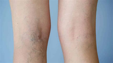 Perna Inchada E Roxa - Manchas roxas nas pernas, do nada, após treino: o que causa? – Saúde ...