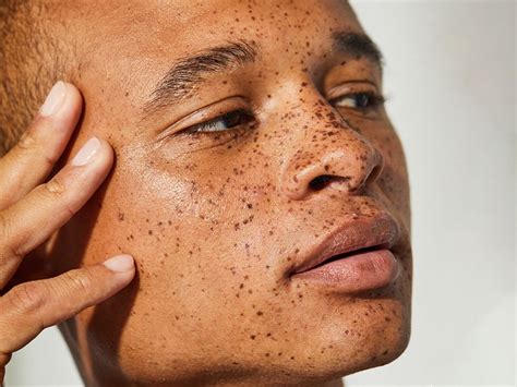 Closed Comedones: Causes, Treatments and Prevention | Skincare.com