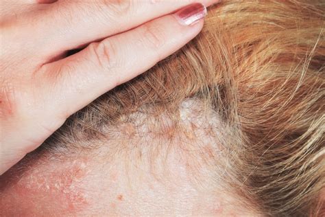 Patients debate how to treat psoriasis on scalp without chemicals 32