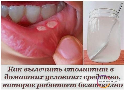 Чем лечить стоматит во рту у взрослых: фото, лечение, средство, как ...