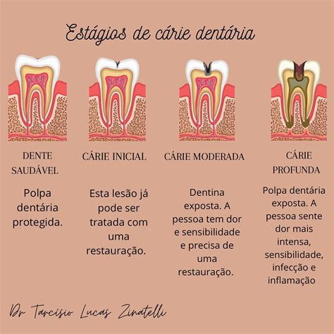 Como Se Desenvolve A Carie - Estagios De Carie Dentaria O Que é Cárie Dentária? Tipos, Sintomas,