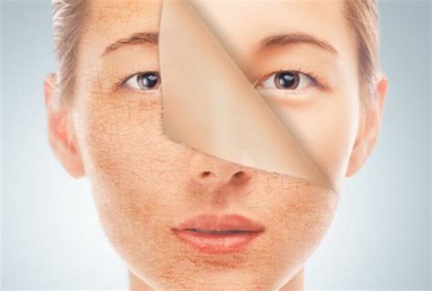 Ретиноловый пилинг (Retinol peeling) для лица. Эффект, фото до, после