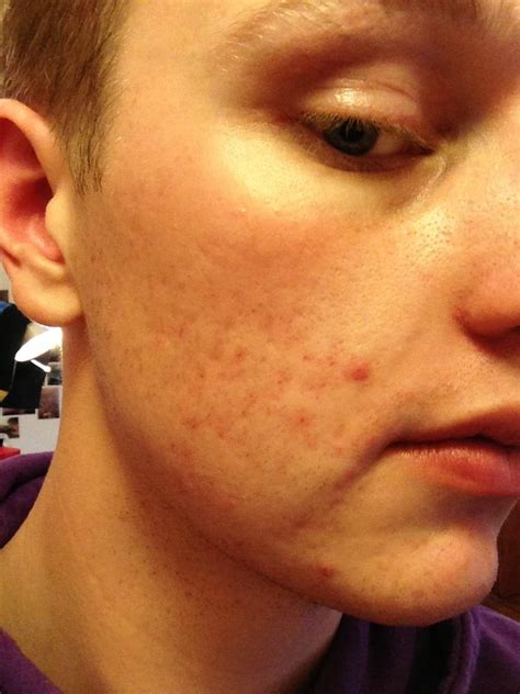 how to get rid of acne reddit