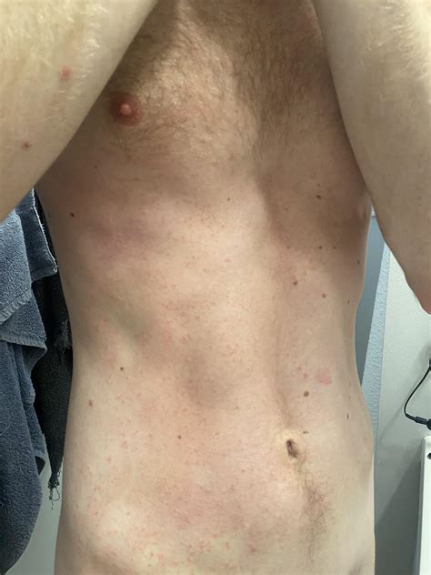 Trunk rash reaction, likely to Doxycycline Mono 200 mg/day - any advice