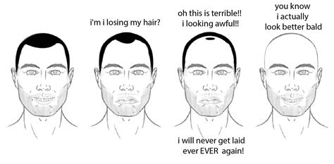 Male Pattern Hair Loss Stages