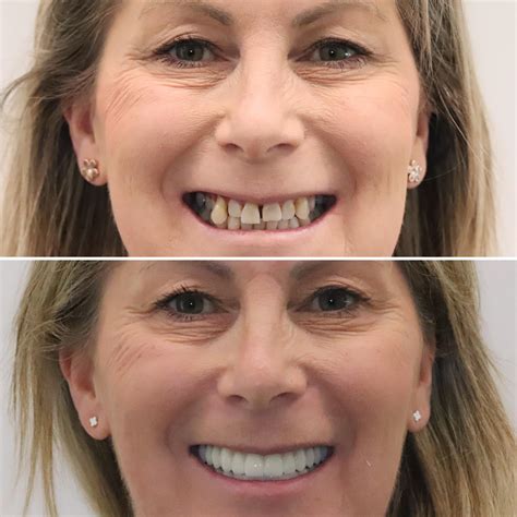 Geelong Implant Institute | Official ALL-ON-4® Centre Of Excellence