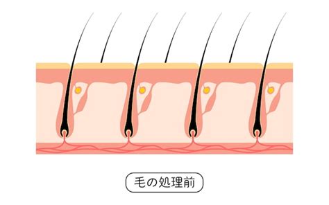 Premium Vector | Image of hair removal before and untreated hair ...