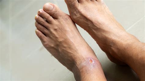 Diabetic Foot Ulcers: Images, Causes, and Treatment - GoodRx