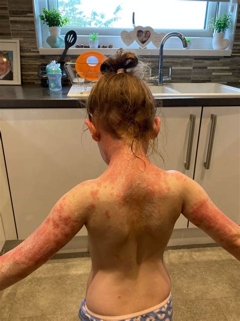 Scots mum warns of Strep A 'sunburn skin' symptom - Daily Record
