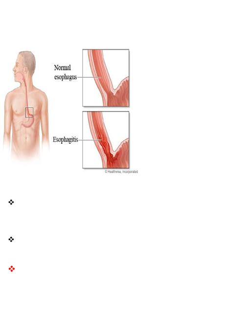 7 Surprising Ways To Heal A Sore Esophagus