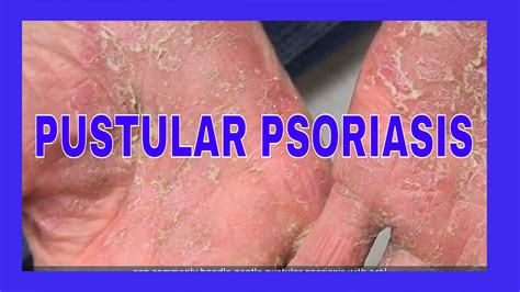 pustular rash  symptoms  treatments geox
