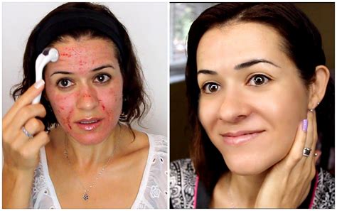 Como Fica O Rosto Após Microagulhamento