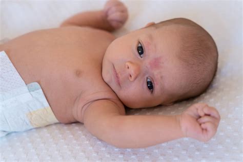 Mancha Salmao Em Bebe