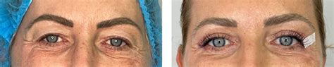 Augenlidstraffung - A Plus Klinik Heilbronn
