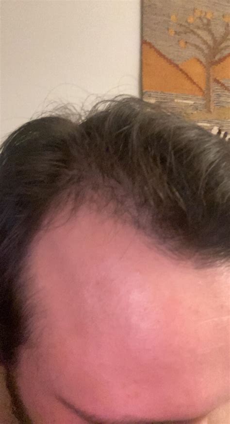 Is my hair thinning? : r/malehairadvice