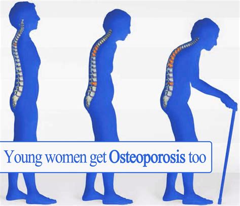 Osteoporosis Affects Younger Women Too