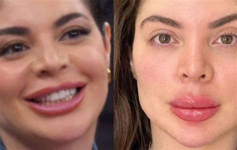 Harmonização facial de Gkay tem antes e depois surpreendente! - Purepeople