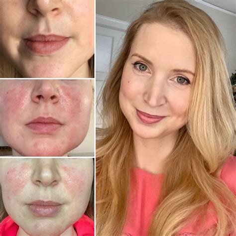 Staph Infection On Lips