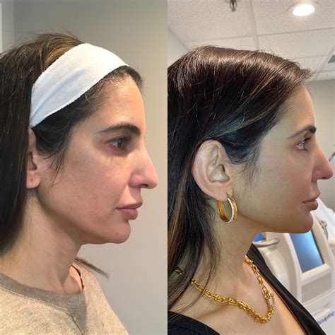 face thread before and after 3