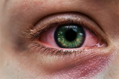 Conjunctivitis (Pink Eye): Symptoms, Treatment & Prevention - Health A to Z