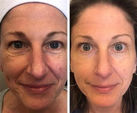 PRP Injections Overland Park - Evolution Precision Medicine