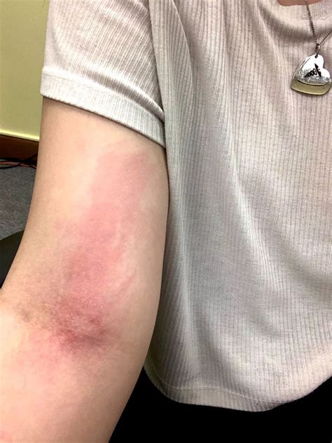 Student allergic to her own tears suffers cuts on tongue when she