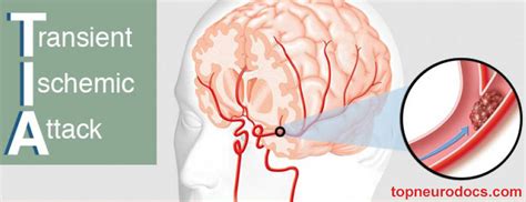 Transient Ischemic Attack (TIA) | Stroke | Top NeuroDocs