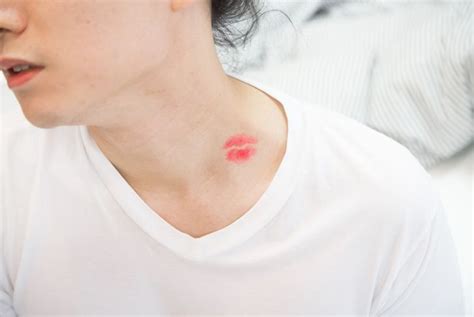 20 Tested Tips For How to Get Rid of a Hickey - The Habitat