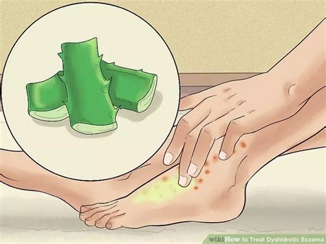 How to treat dyshidrotic eczema 8 effective home remedies – Artofit