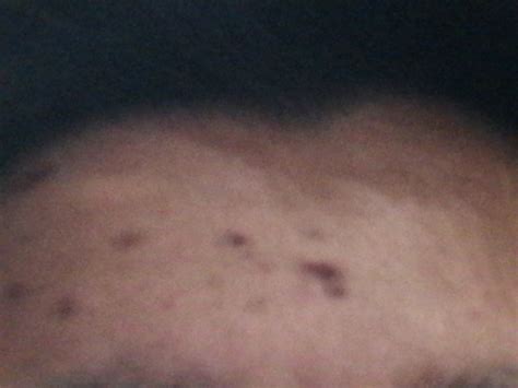 Forehead acne scars – Scar treatments – Acne.org Forum