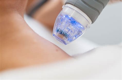 microneedling  waukesha wi jp beauty services