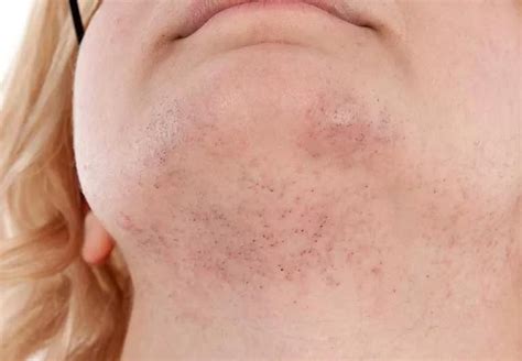 Why Women Get Chin Hair and Treatment Options
