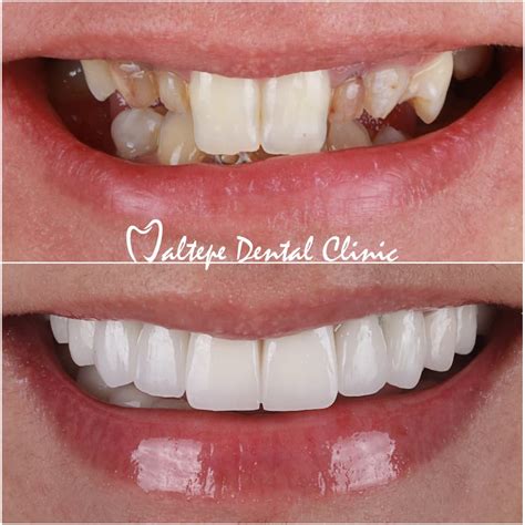cosmetic dentistry options  crooked teeth maltepe dental