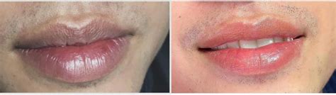 fractional  laser resurfacing benefits recovery