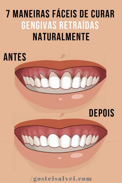 Gengiva Retraida Tratamento Caseiro
