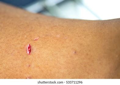 Dog Bite Wound Stock Photo 533711296 | Shutterstock