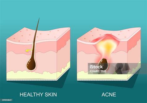 acne cross section   human skin  pimple stock illustration