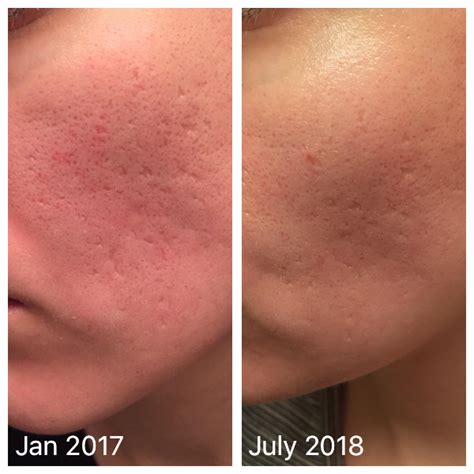 1085 best Acne Scars images on Pholder | Skincare Addiction, Acne and