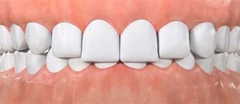 deep bite  effects  treatment options